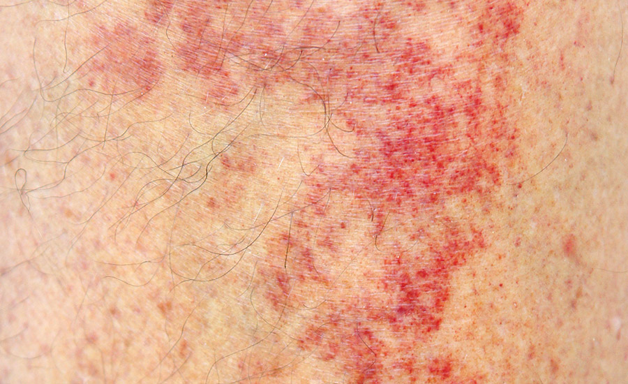 PSA Wound Dressing Adhesion and Skin Type A Delicate Balance